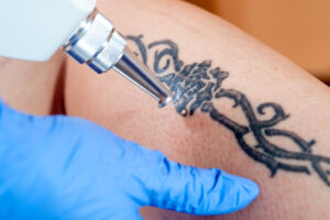 A los millennials les encantaban los tatuajes; ahora están haciendo de la eliminación con láser la próxima gran tendencia